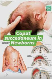 Image result for Vacuum Caput