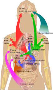 Surgical removal is the most common treatment, but. Cancer Metastasizes To The Bone Marrow And Not To The Bone Time For A Paradigm Shift Springerlink