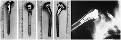 Image result for Shoulder History