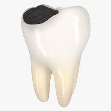 3d Teeth Decay Tooth Decay Teeth Models For Sale