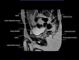 The key feature is a deep concavity of the expected uterine fundus, with a cleft of at least 1 cm diagnostic. Radiology Anatomy Images Male Pelvis Mri Anatomy