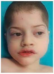 Genes Free Full Text Pitt Hopkins Syndrome Clinical And Molecular Findings Of A 5 Year Old Patient Html