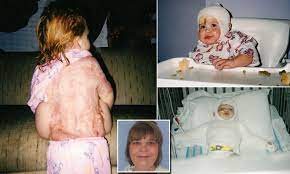 Horrific Photos Of A Little Girl S Third Degree Burns Sees Alabama Parole Board Refuse Early Release Of Woman Who Put Her Baby Daughter Into A Hot Oven 14 Years Ago Daily Mail