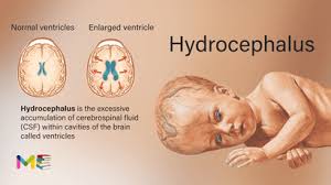 Image result for Hydrocephalus