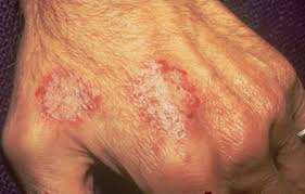 Image result for Eczema nummulare