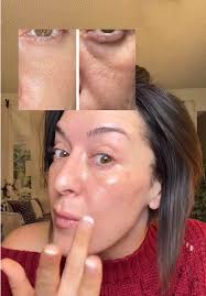 Fordyce Spots under Eye Laser Treatment