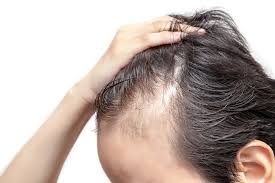 Many patients also do not realize at all that their hair loss may be. Guidedogswa Can Thyroid Cause Hair Loss
