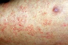 Image result for scabies in the groin area
