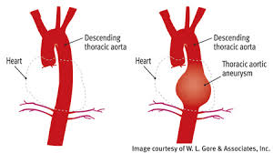 It arises when a segment of the vessel wall is weakened due to any number of factors and this causes a bulging. Aortic Aneurysm Cardiac Surgery Michigan Medicine University Of Michigan