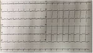 Image result for Flecainide Overdose