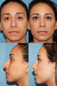 When it comes to nose jobs, these 3 stars pop up the most. Rhinoplasty For Upturned Nose Fixing 15 Best Rhinoplasty