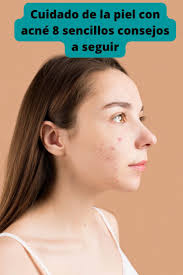 Cuidado de la piel con acné 8 sencillos consejos a seguir