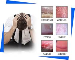 Image result for Balanitis