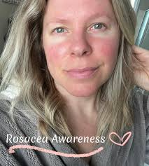 I debated about posting these images here. Mostly because of my fear of  judgment. But the whole point of my page is to show REAL skin and real skin  issues. It's Rosacea