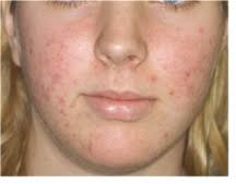 Vulgaris Acene Medicine For Treating Antibiotic Remedy