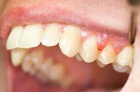 Image result for Gingivitis