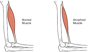 Today, sarcopenia is considered to be a loss of muscle mass in an older person, which is 2 sds less than the mean for young persons.1 sarcopenia can be . Muscle Atrophy Wikipedia