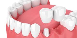 For starters, there are four different types of dental bridges and the way a dental bridge looks will depend on what type of bridge it is. 7 Important Key Points To Know About Dental Bridges