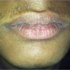 Hirsutism is excessive body hair on parts of the body where hair is normally absent or minimal. Excessive Hair Growth Over Upper Lip And Chin Download Scientific Diagram
