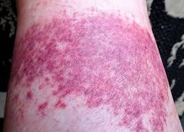 Image result for Vasculitis