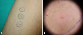 Image result for Pathergy