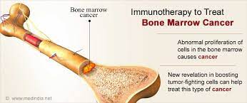 Bone Marrow Cancer New Insights Into Boosting Tumor Fighting Cells