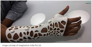 Fusion 360 Touching Lives Broken Bone Touching Lives Wrist Brace