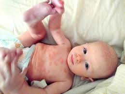 Image result for Cradle Cap
