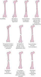 Uberblick Uber Knochenbruche Verletzungen Und Vergiftung Msd Manual Ausgabe Fur Patienten