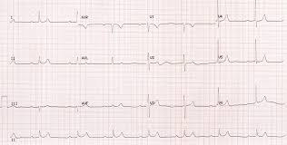 Image result for Hypermagnesemia