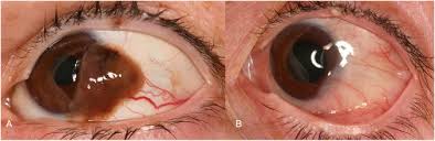 Image result for conjunctival melanoma