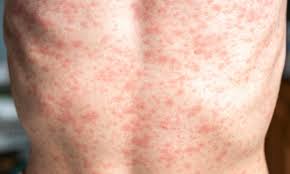 Image result for measles
