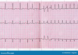 Image result for Extrasystole