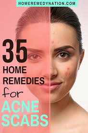 Blocks acne triggers & promotes healthy cell growth. How To Get Rid Of A Scabbed Over Pimple