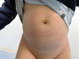 Image result for Inguinal hernia child