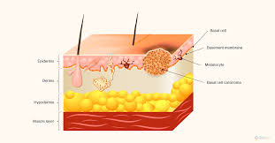 Skin cancer symptoms and treatment. Basal Cell Skin Cancer Symptoms Signs Treatment Causes Diagnosis