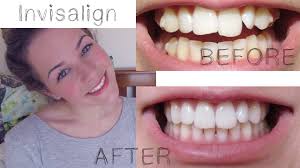 How long does it take to see results from invisalign? My Invisalign Treatment Youtube