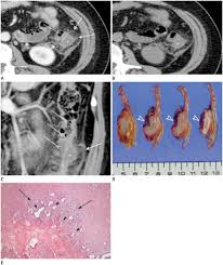 The new york endometriosis center which is one of the leading endometriosis treatment and gynecologic surgery centes in the world with offices in new york and greenwich. Descending Colon Endometriosis Misdiagnosed As Diverticulitis A Case Report