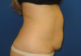 We did not find results for: Tummy Tuck The Center For Plastic Surgery Skin Care