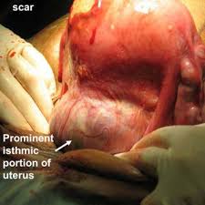 Uterine Findings During Laparotomy Note Caesarean Section Scar At Download Scientific Diagram