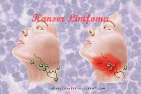 Apa itu sistem hukum eropa kontinental? Apa Itu Kanser Limfoma Lymphoma Kenali Kanser
