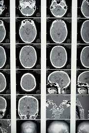 The link between gut microbiome and brain health