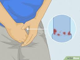 Image result for human papillomavirus symptoms