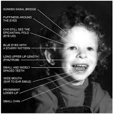 Fetal alcohol syndrome epicanthal folds flat nasal bridge small palpebral fissures upturned nose. Spotlight On Syndromes An Slps And Ots Perspective On Williams Syndrome Smart Speech Therapy