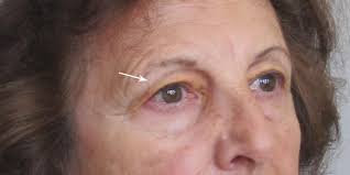 Image result for xantelasma