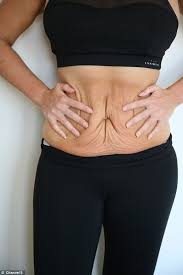 My highest weight was 260lbs and i have had the same shape stomach/breasts/thighs since i was about 11 years old patientold. 4 Ways To Help You Deal With Loose Skin After Weight Loss The Daily Crisp
