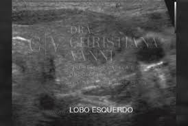 TI-RADS 5 é Câncer? O Que Significa?