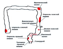 Zdorovaya Krov Krovyanistye Vydeleniya V Kale Home Health Zdorovayakrov Rassylka Subscribe Ru