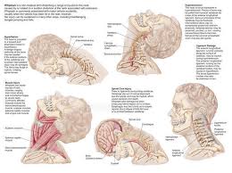 medical chart with the range of injuries to the human neck