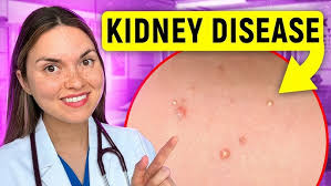 Image result for scabies bite